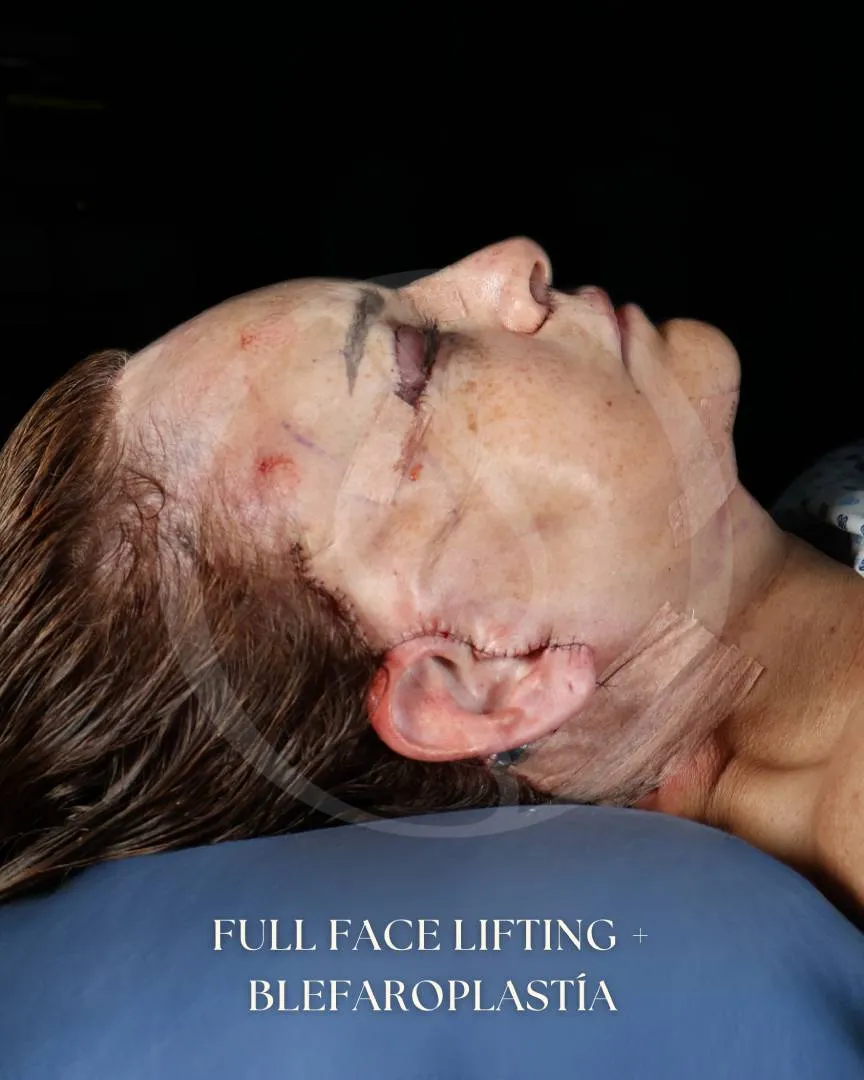 Lifting Facial