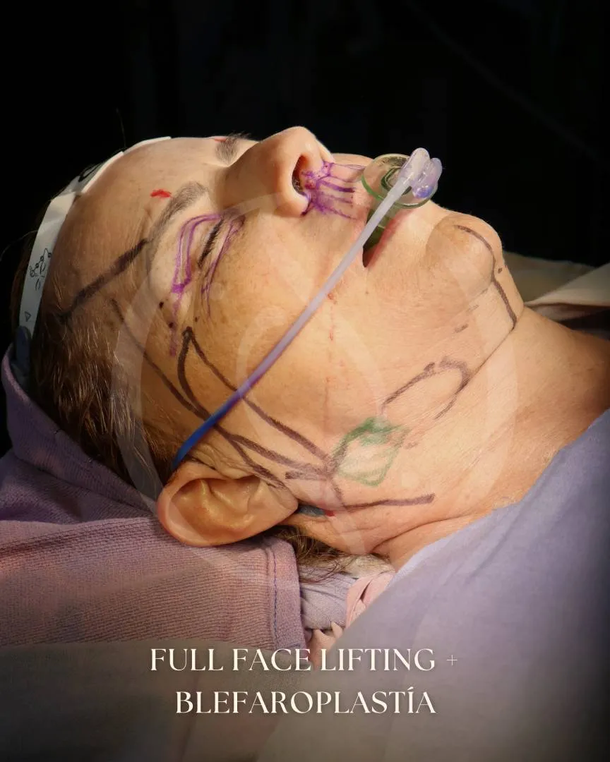 Lifting Facial