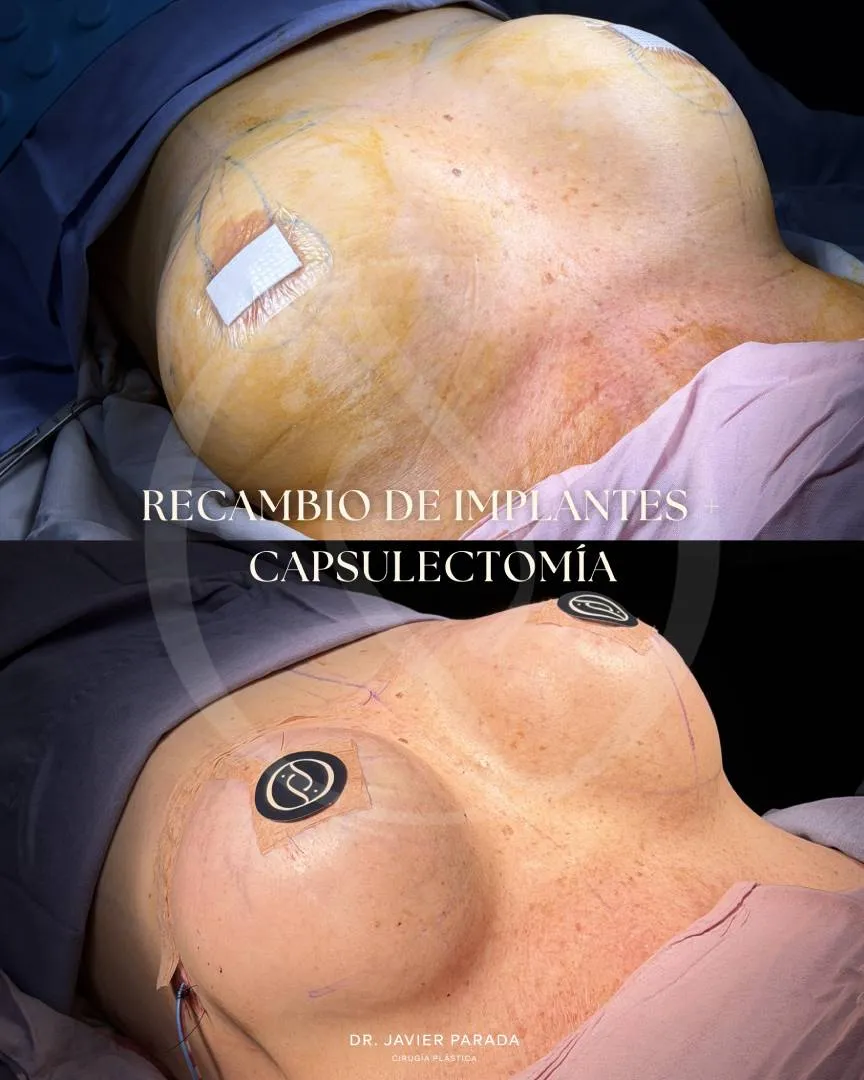 Mamoplastía