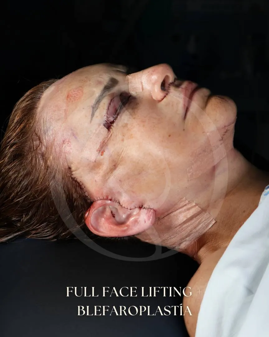 Lifting Facial