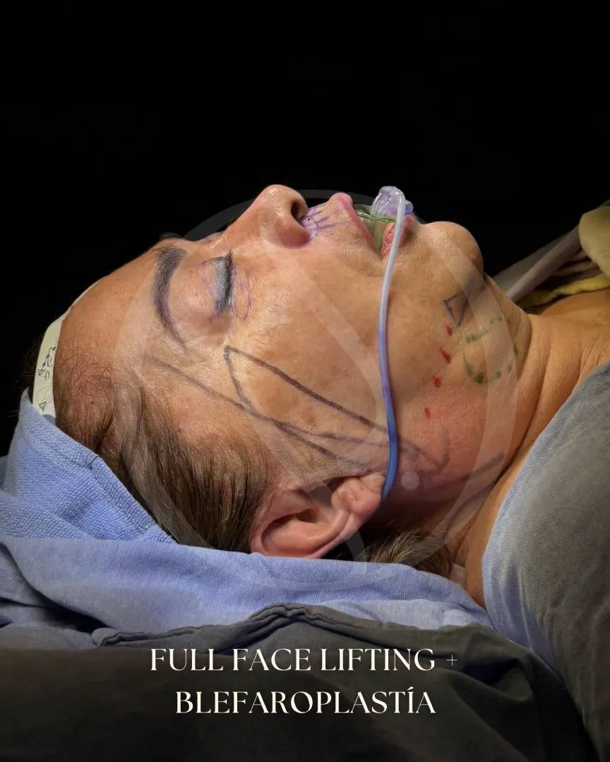 Lifting Facial