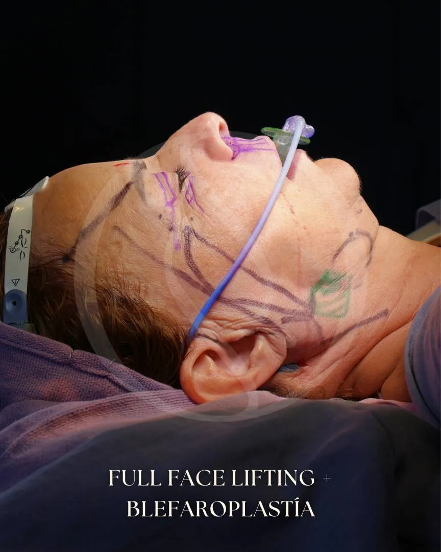 Lifting Facial