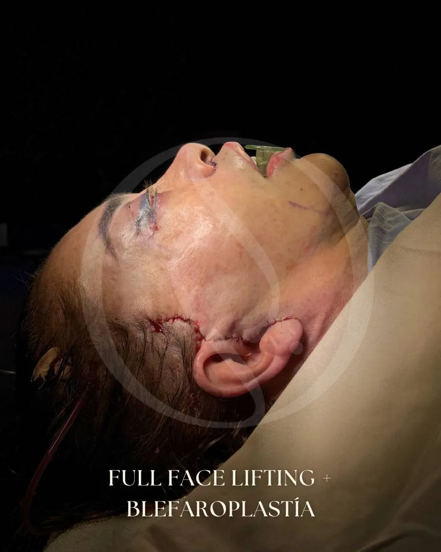 Lifting Facial