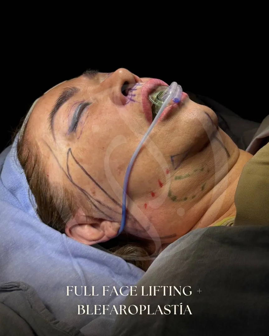 Lifting Facial
