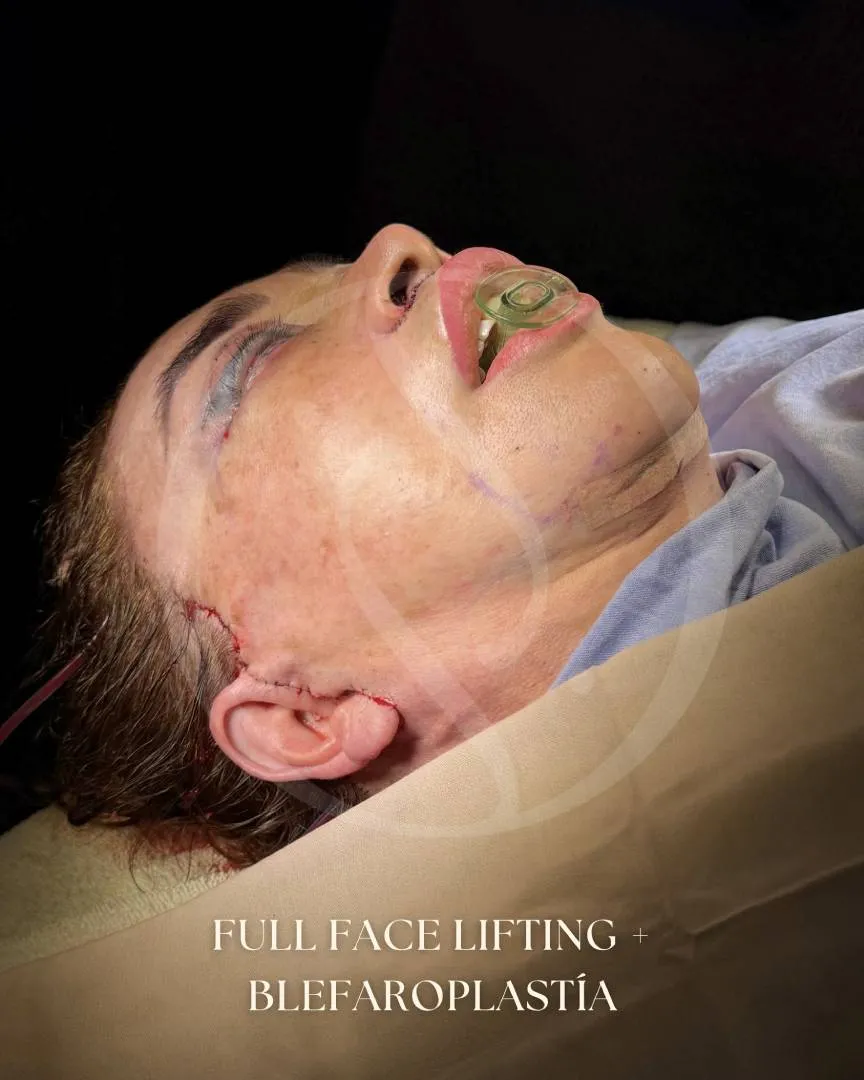 Lifting Facial