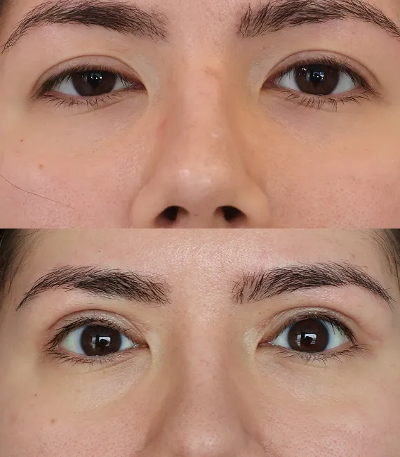 Blefaroplastia