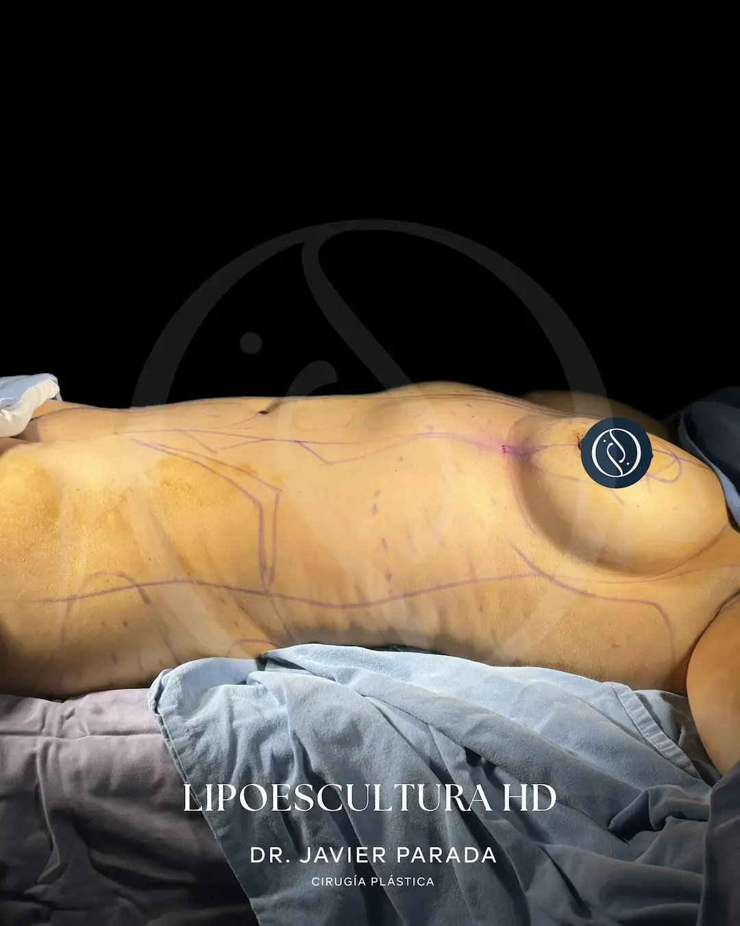 Lipoescultura