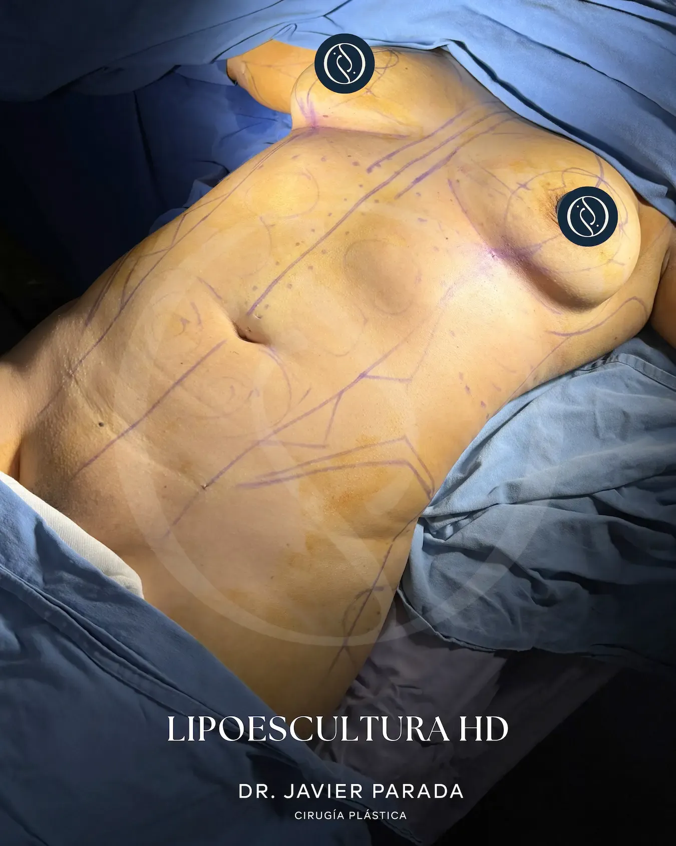 Lipoescultura
