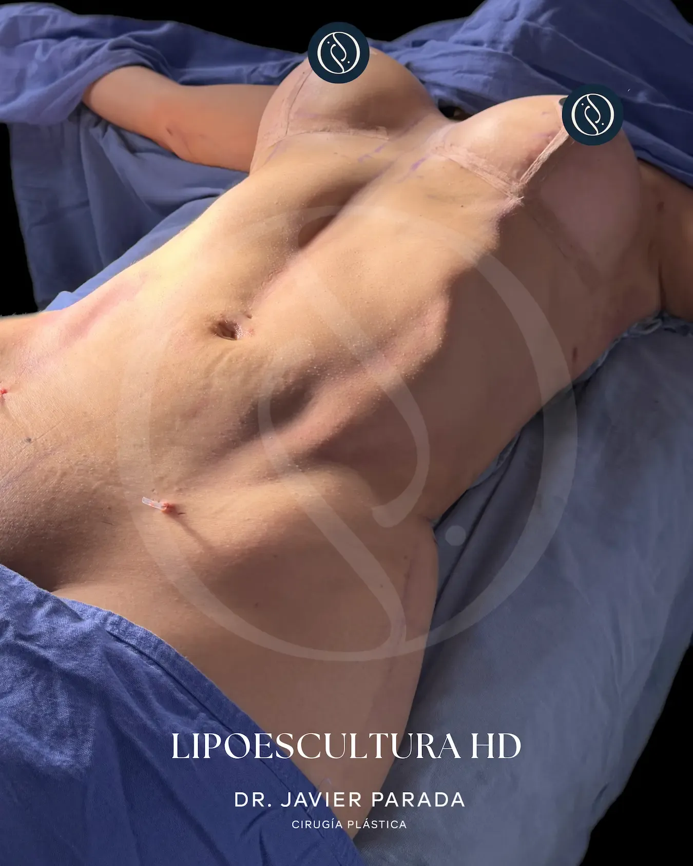 Lipoescultura