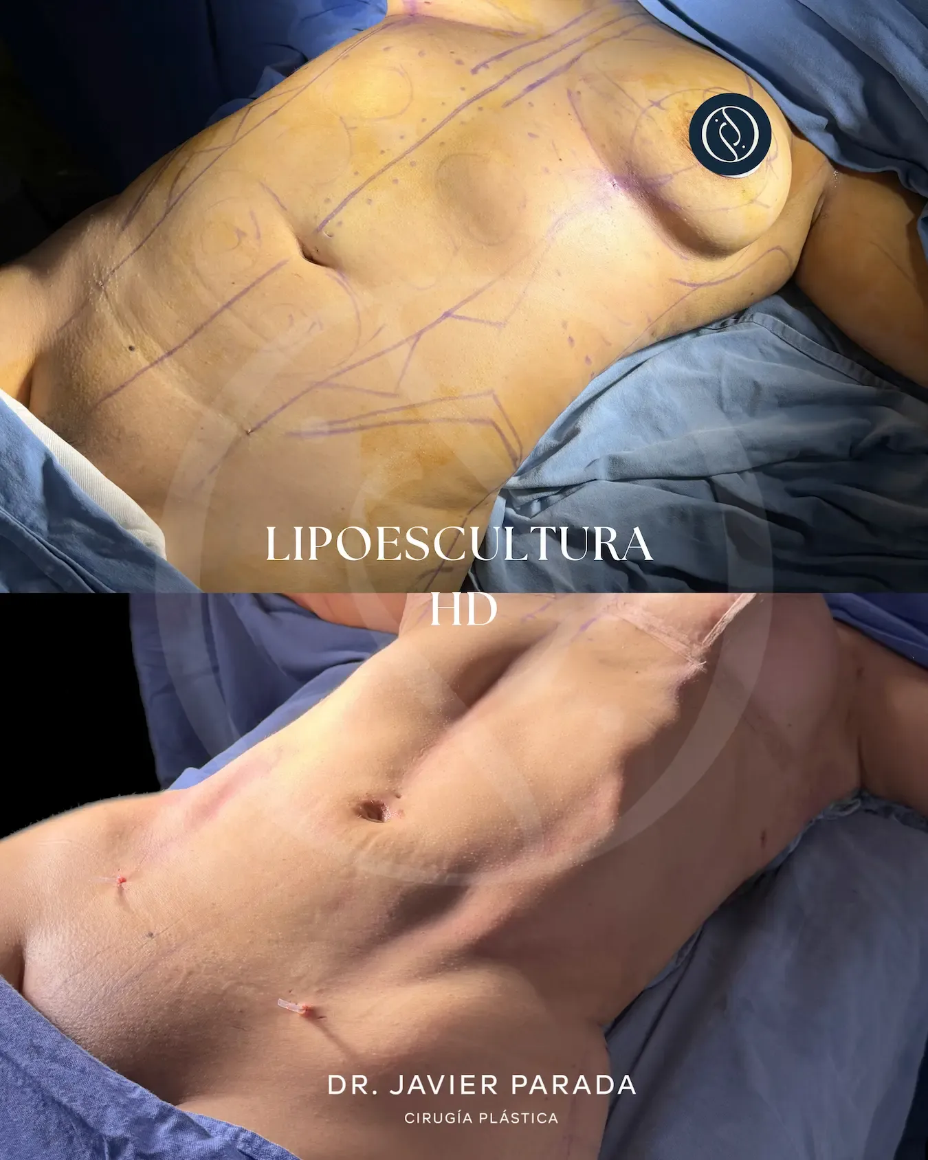 Lipoescultura