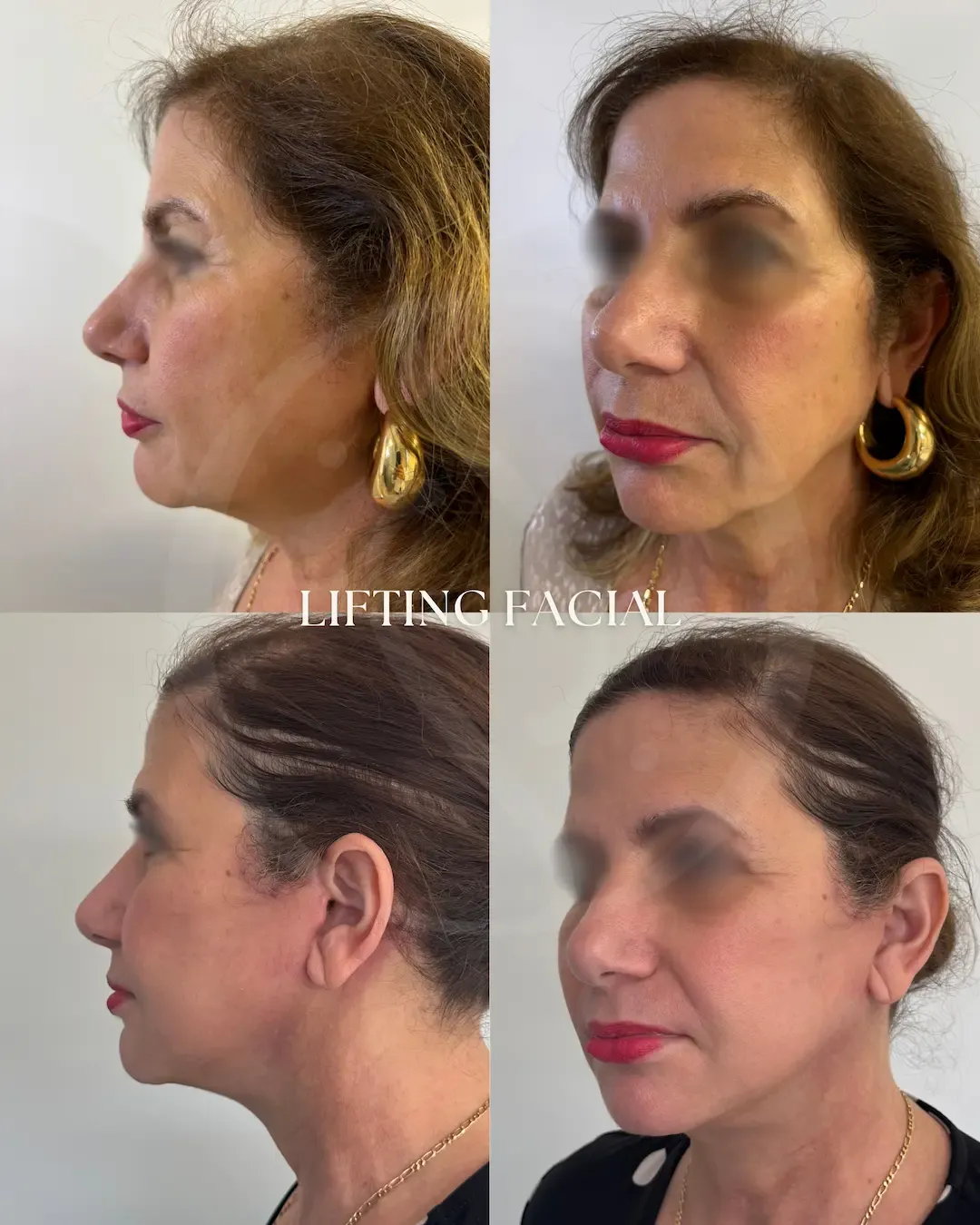 Lifting Facial