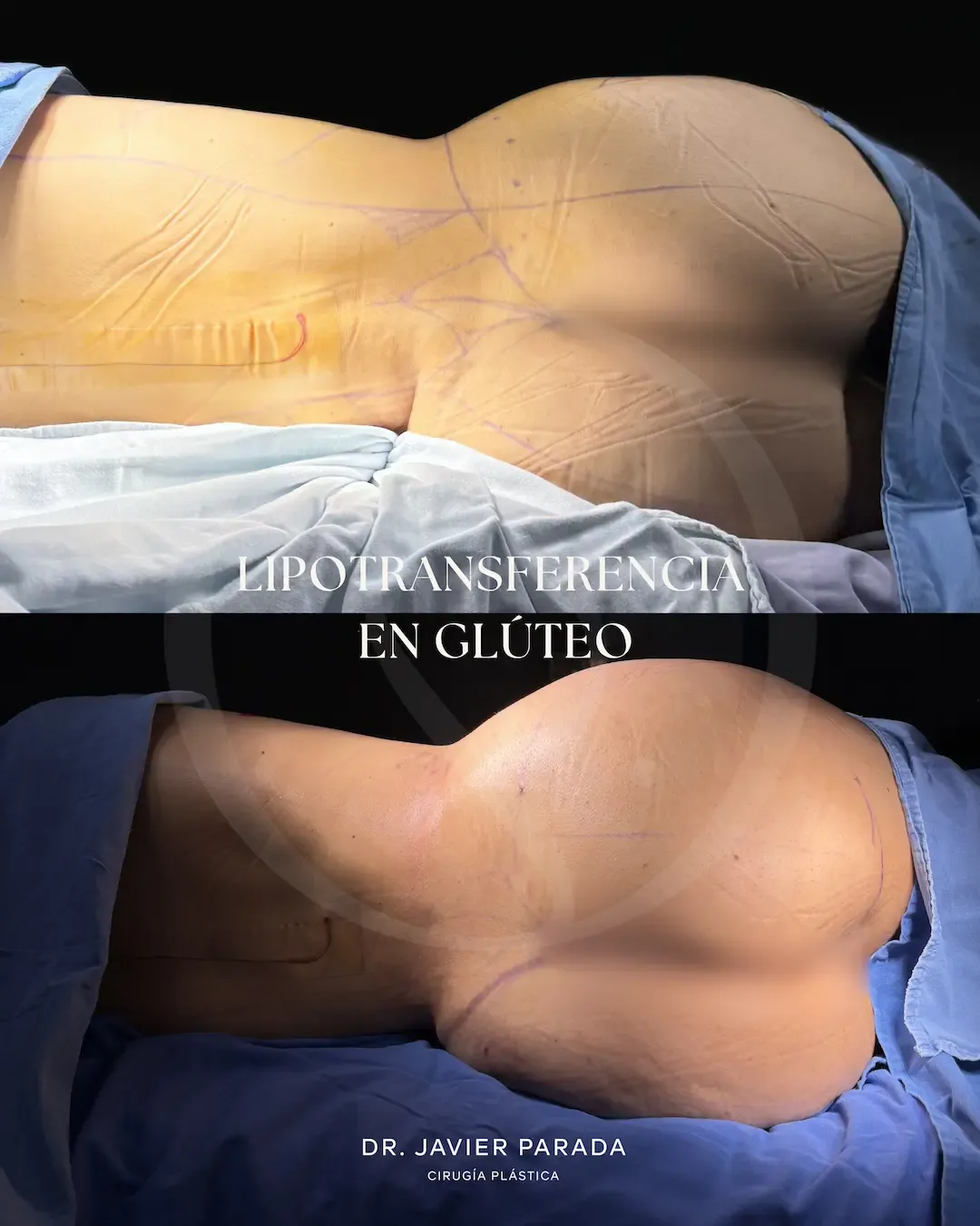 Lipoinyección Glútea