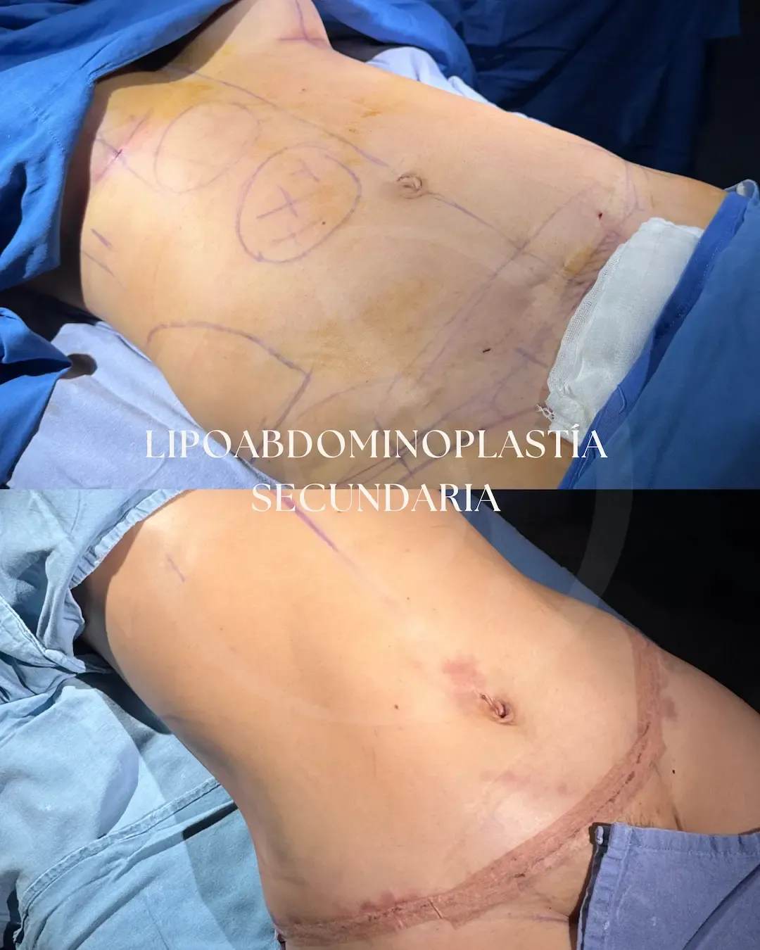 Liposucción