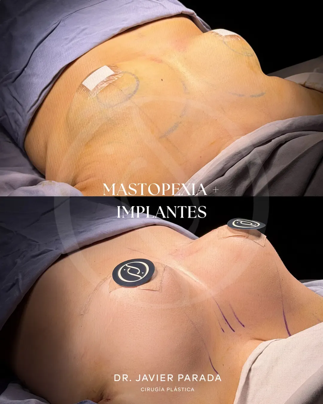 Mamoplastía