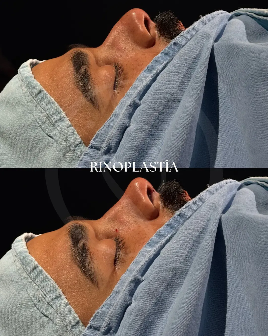 Rinoplastía